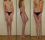 Marfan_Patient