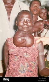 woman-with-goiter-HRF63X