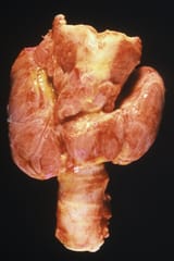 Thyroid,_Diffuse_Hyperplasia