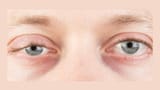 Myasthenia-gravis-symptoms-causes-16432213