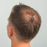 crown_hair_thinning_man_0b38cff7-08e7-4f10-a7cc-937740360796_940x