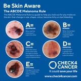 The_ABCDE_Rule_-_Skin_Cancer_-_PNG