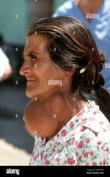 honduras-1993-sixty-year-old-woman-with-a-large-goiter-on-her-throat-waits-in-line-at-a-rural-health-clinic-bob-daemmrich-2B3RPNH