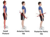 anterior-pelvic-tilt