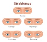 strabismus
