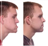 jawwline surgery