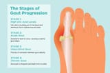 0919_Stages_Gout-1024x683