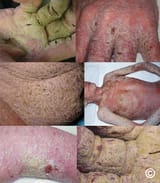 norwegian_scabies_5_fee391183f15cb4d62773032fe0be92d
