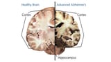 Alzheimers Brain