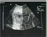 oblivion ultrasound