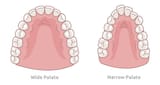 wide vs narrow palate