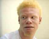 albino