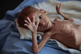 yemen-hunger-child-ap-ps-181121_hpMain