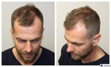 norwood-stage-3-hair-loss