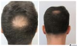 norwood-stage-3-vertex-hair-loss