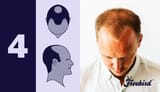 Stage_4_-_The_Norwood_Scale_Stages_of_Male_Pattern_Hair_Loss-3645702006