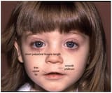 fetalalcoholsyndrome