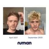 thomas-hair-regrowth-story-2