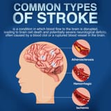 types-of-stroke-1024x1024