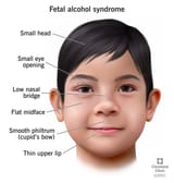 15677-fetal-alcohol-syndrome