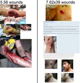 5.56 vs 7.62 wounds