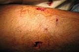 M855_wound
