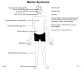 marfan_syndrome