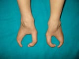 ectrodactyly2