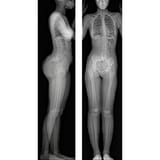 eos-full-body-xray-1