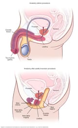 penile-inversion-8col
