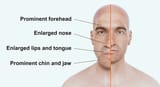 Acromegaly-face