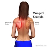 winged-scapula