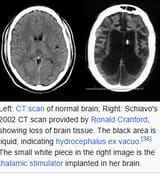 schiavobrain