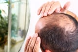 alopecia-male-hair-loss-1