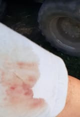 dog bite