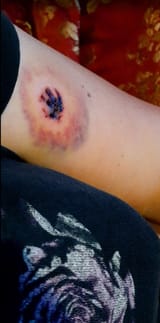 pitbull bite