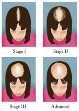 female-pattern-hair-loss-d9cee1