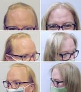 feminization-of-hairline-example