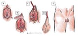Figures-Tables-EMJ-Urol-8.13