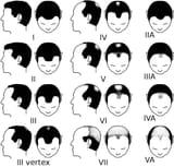 Norwood-scale-for-male-pattern-baldness