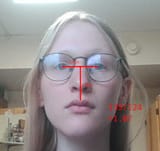 midface