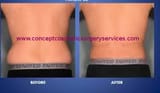 lipo-surgery