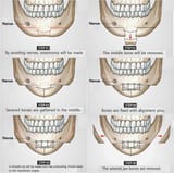 dia+v+line+mandible+jaw+surgery+id+the+best+plastic+surgery+hospital+breast+augmentation+fat+grafting-1996167503