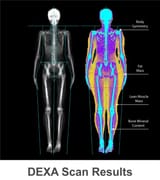 fat distribution dexa scan