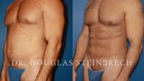 body-contouring-results-new-york