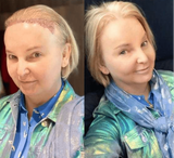 india-willoughby-before-and-after-hair-transplant