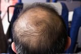 man-balding-on-crown