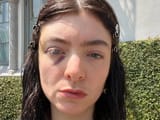 lorde-worries-fans-photos-bruised-black-eye-deleting-instagram-posts-1-1727725238651
