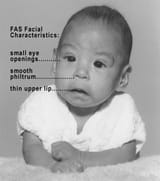Photo_of_baby_with_FAS