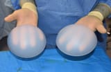 400cc-buttock-implants-Dr-Barry-Eppley